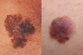 Since the leg has several parts that come together to form the leg, so does hematoma also affect the various parts of the leg. Skin Cancer Pictures 5 Different Types Of Skin Cancer To Know