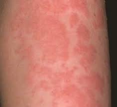 Se hai intossicazione alimentare, ti starai chiedendo quando ti sentirai meglio. Quali Sono Le Cause Di Eruzioni Cutanee O Orticaria