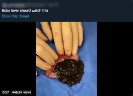 Batu hempedu pada saluran biliari menyebabkan aliran 'bile' berlaku pada arah yang berlawanan. Konon Boba Tersekat Dalam Hempedu Doktor Jelaskan Rupanya Itu Video Batu Dalam Hembepdu