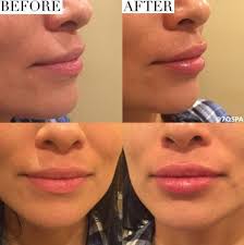 Before After Lip Fillers Using Juvederm Ultra Plus Xc 1 2 Syringe Was Used To Achieve A Natural Pout Will Look Lip Fillers Lip Fillers Juvederm Juvederm Lips