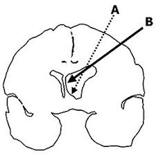 Pdf Results Of Endoscopic Septal Fenestration In The Treatment Of Isolated Ventricular Hydrocephalus
