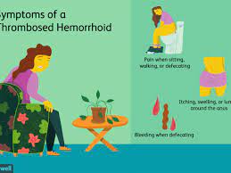 Most thrombosed hemorrhoids will resolve on their own, although it may take two to three weeks for them to be completely gone. Thrombosed Hemorrhoid Symptoms And Treatment