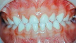 Image result for Dentition