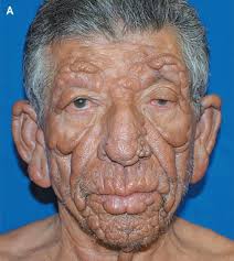 Home of the Hansen's Disease