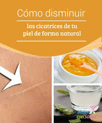 Como Disminuir Las Cicatrices De Tu Piel De Forma Natural Cicatrices Remedios Naturales Natural