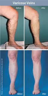 Unlike others, our facilities are designed exclusively for vein care. Varicose Vein Treatment Northpointe Medical