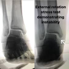 Image result for Ankle External Rotation Test
