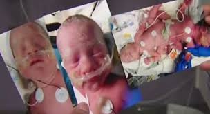 2 babies from newborn triplets conjoined