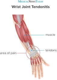 Nov 01, 2012 · the achilles tendon is the thickest and strongest tendon in your body, connecting your calf muscles to the back of your heel. Wrist Tendonitis Treatment Symptoms Causes And More