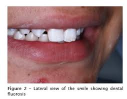 Microabrasion And Composite Resin For Re Establishing Smile Esthetics A Case Report