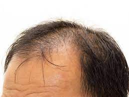 Caduta di capelli nei giovani, tutto quello che c'è da sapere. Perdita Di Capelli Nell Uomo Tutto Sulla Calvizie Maschile Blog