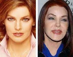 Full article · prev image next image. Plastic Surgeon Utah Salt Lake City Cosmetic Surgery Utah Plastic Surgery Plastic Surgery Gone Wrong Bad Plastic Surgeries
