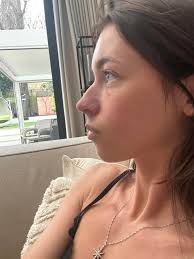 Rhinoplasty in Turkey