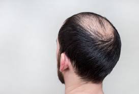 It's super common for men to start losing their hair, especially as you get older courtney foster is a licensed cosmetologist, certified hair loss practitioner, and cosmetology educator based out of new york city. Signs Of Balding In Men And What To Do About It Regenrx