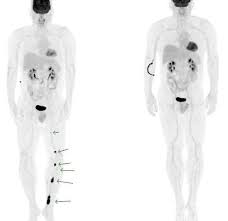 Blood cancer cure is a common type of cancer majorly attacks the blood, bone marrow, or lymphatic system. New Immunotherapy Drug Effective For Melanoma Other Cancers