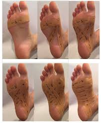 Should i go to doctor for plantar fasciitis? Can You Cure Plantar Fasciitis In One Week
