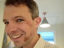 Aberdeenshire MP shares bruised face after accident but not everyone sees  the funny side