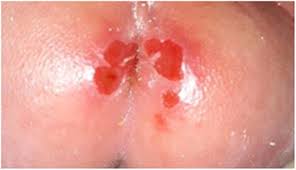 Image result for diaper dermatitis