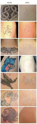 Paradise tattoos ltd, halifax, united kingdom. Laser Tattoo Removal Yorkshire Laser Aesthetics