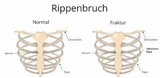 Rippenbruch Rippenfraktur Rippenserienfraktur