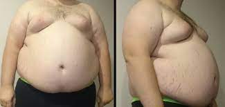 Metabolic Syndrome Wikipedia