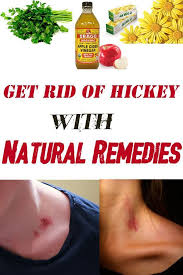 How To Get Rid Of Hickey With Natural Remedies Remedies Home Remedies Beauty Natural Remedies