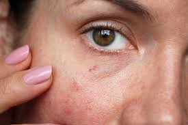 Image result for red rash face