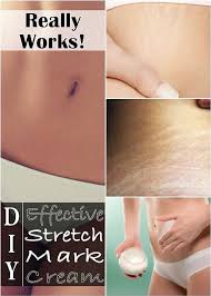 Women Attire And Hairstyles Diy Effective Stretch Mark Cream Diy Stretch Marks Cream Stretch Mark Cream Marks Cream