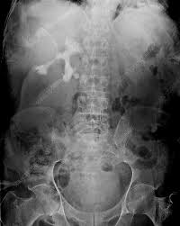 Staghorn Kidney Stone X Ray Stock Image M195 0159 Science Photo Library