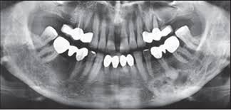Check spelling or type a new query. Focal Cemento Osseous Dysplasia Gumusok M Alkurt Mt Hamurcu K Kilavuz Dk Baris E Simsek B J Oral Maxillofac Radiol