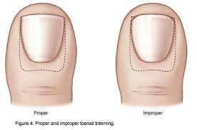 Prevent Ingrown Toenails Ingrown Toe Nail Ingrown Nail Healthy Nails