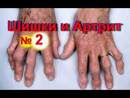 как избавиться от мозолей на пальцах ног народными средствами Shishki Na Palcah Ruk Kak Izbavitsya Ot Shishek Na Palce 2 Artrit Sustavov Na Rukah Youtube Artrit Ruki Zdorove