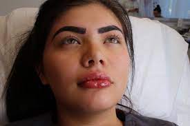 There's a problem loading this menu right now. Buyer Beware Risks Of Buying Hyaluronic Acid Fillers Online For Plumper Lips Microbladers Studio Academy Las Vegas Nv