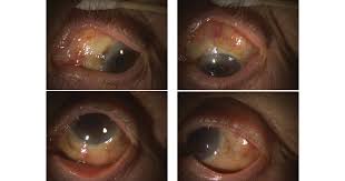 Image result for melanosis sclera