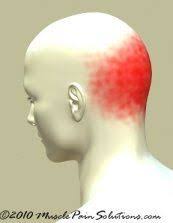 Trigger Points For Occipital Headache Neck Headache Headache Occipital