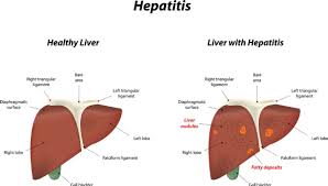 Treatments for children's cancer which can cause liver problems. Hep C In Baby Boomers Unrelated To Risky Behaviour Researchers Say The Star