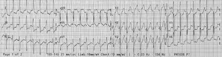 Learn vocabulary, terms and more with flashcards, games psvt clinical associations. Paroxysmal Supraventricular Tachycardia Diagnosis And Management