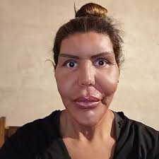 Ya teniendo l cejas tatuadas hoy fue el turno d l boca,1ra seción y obvio  está un poco inflamada,en l próximas seciones s viene color, gracias a m  amiga @sararamirezmakeup x esté