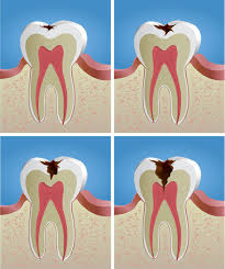  dieu-tri-sau-rang-giai-doan-som-tai-khoang-va-fluoride