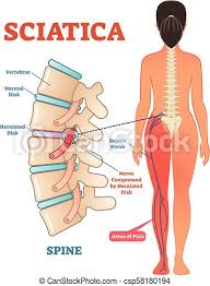 Still many individuals pay far too little attention to them. Sciatica Medical Health Care Vector Illustration Diagram Scheme With Lower Spine And Sciatic Nerve Pain In Leg Sciatica Canstock