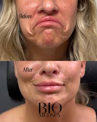 Aging gracefully isn't just about smoothing the forehead. We treat the DAO  (depressor anguli oris) muscles to soften that downward pull at the corners  of the mouth. Over time, strong DAOs can