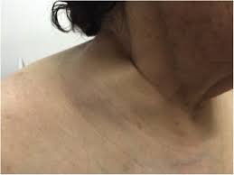 Symptoms of inflammatory breast cancer include swelling (edema) and redness (erythema) that affect a third or more of the breast. Primary Breast Lymphoma A Mimic Of Inflammatory Breast Cancer Sciencedirect