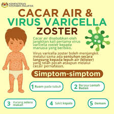 Translations of the word kepala from indonesian to english and examples of the use of kepala in a sentence with their translations: Kkmalaysia On Twitter Cacar Air Virus Varicella Zoster