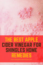 Apple Cider Vinegar For Shingles Natural Home Remedy Cure For Shingles In 2020 Best Apple Cider Vinegar Recipe Using Apple Cider Vinegar Cure For Shingles