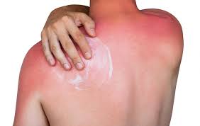Anyone can get skin cancer but as with most cancers the risk goes higher as you grow older. How Long Does Sunburn Last