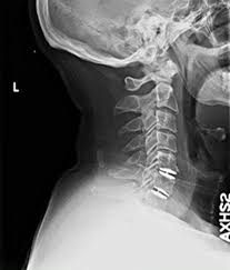 If the motor fibre is pinched then there will be loss of reflex and weakness and wasting of muscles. Cervical Disc Herniation Cervical Radiculopathy And Cervical Myelopathy Neurosurgery