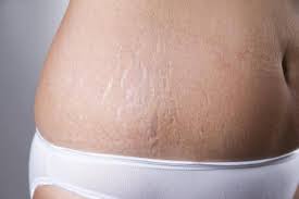 Setelah itu, oleskan ke bagian kulit yang. Cara Menghilangkan Stretch Mark Murah Aman Jakarta Solo