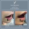 Cherry angioma removal is a common procedure for us here at contour clinics. Https Encrypted Tbn0 Gstatic Com Images Q Tbn And9gcqp9oldsyktmdjrfqk6hznhk5qu6rikzthqscbjr927nm Q4ka7 Usqp Cau