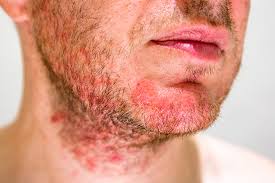 Limfoamele cutanate reprezinta proliferari maligne ale celulelor sistemului imunitar din organele limfoide (ganglionii limfatici) si tesuturile limfoide asociate altor organe (piele, tub digestiv). Remedii Pentru Mancarimile De Piele Meniu Cont Utilizator