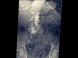 Osteoporose Beeintrachtigt Die Lebenserwartung Erheblich